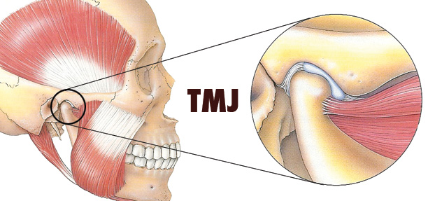 Tmj disorder